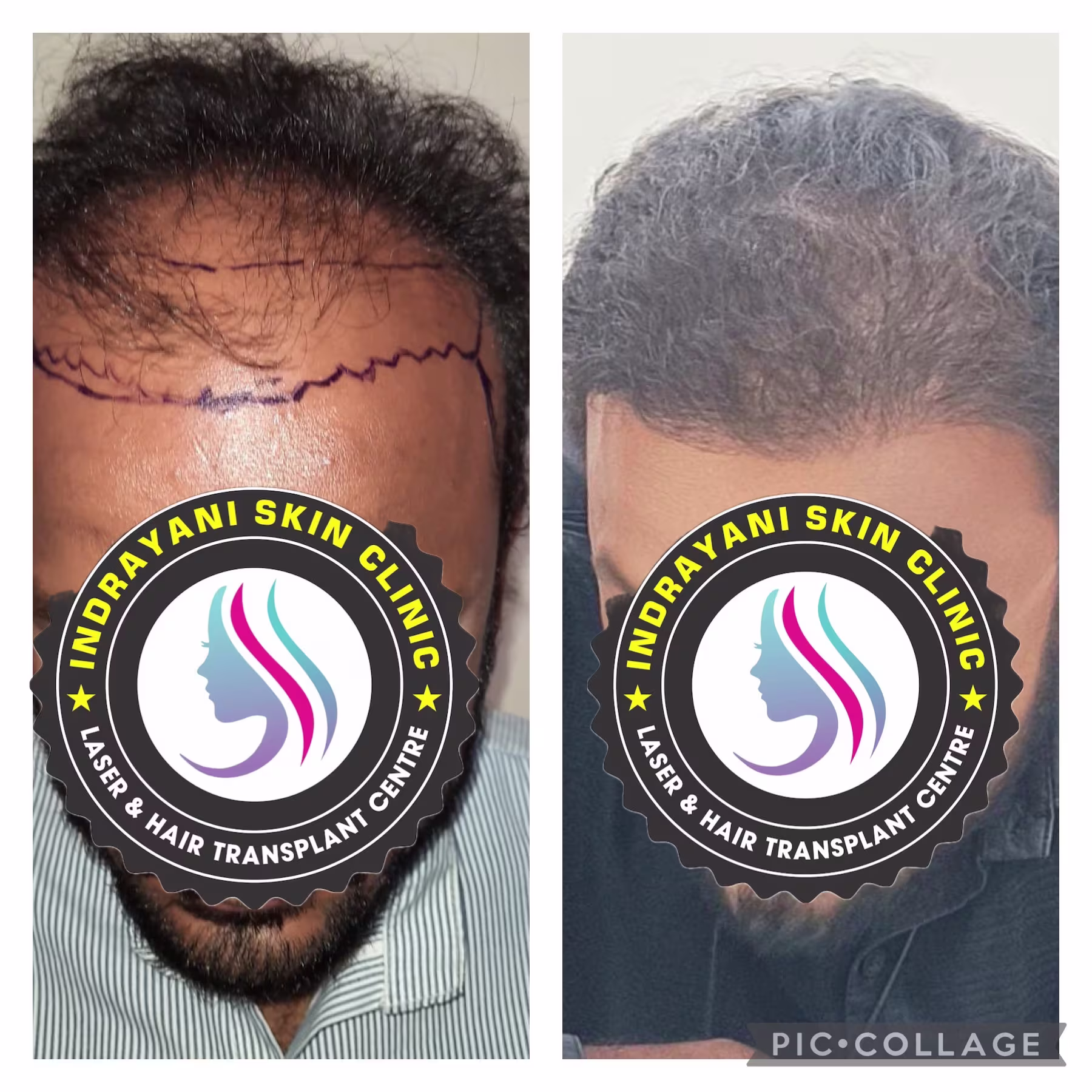 inrayani-skin-clinic-results